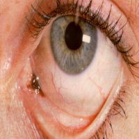 تومورهای ملتحمه چشمی